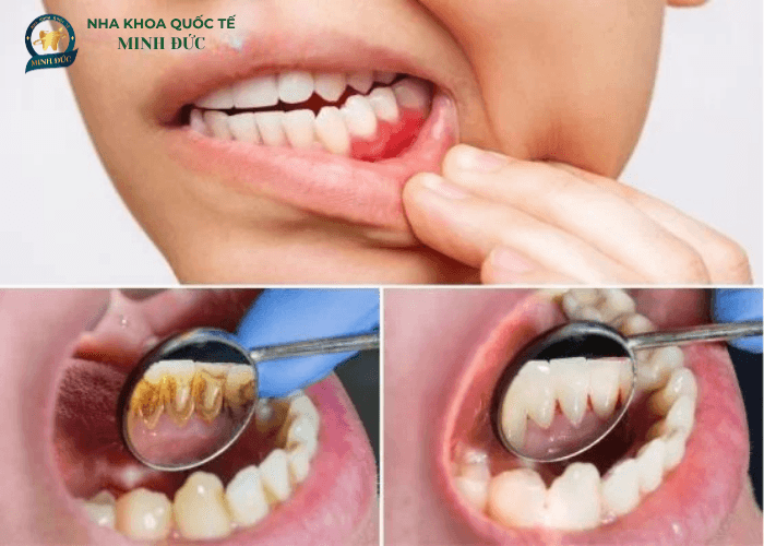 Điều trị nha chu