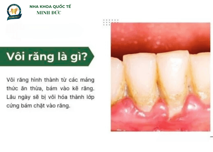 Vôi răng là gì?