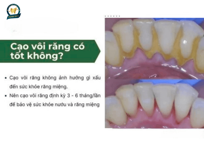 Cạo vôi răng có tốt không?