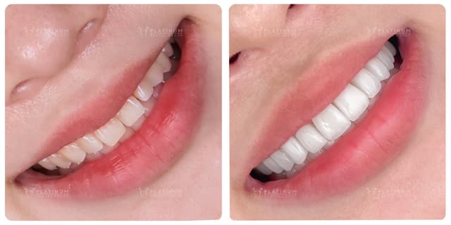 Dán sứ ORODENT