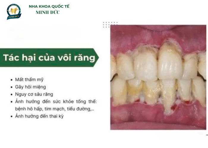 Tác hại của vôi răng