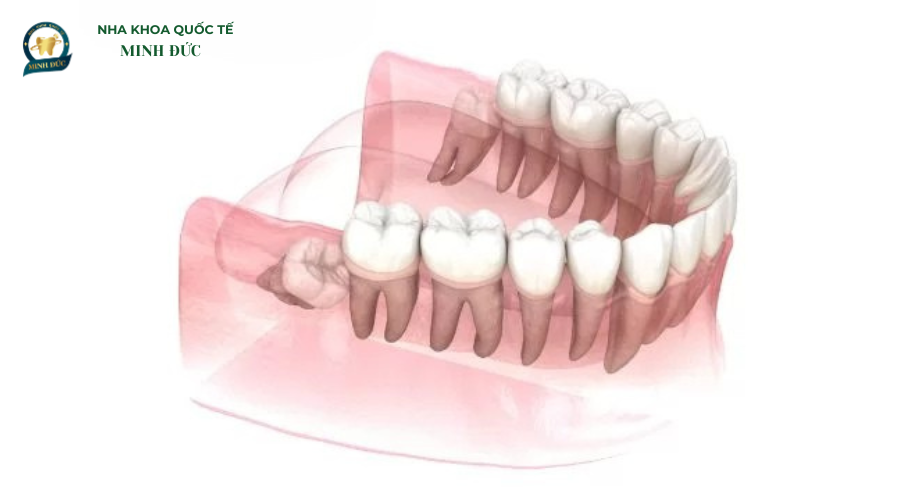 Nhổ răng khôn mọc ngầm